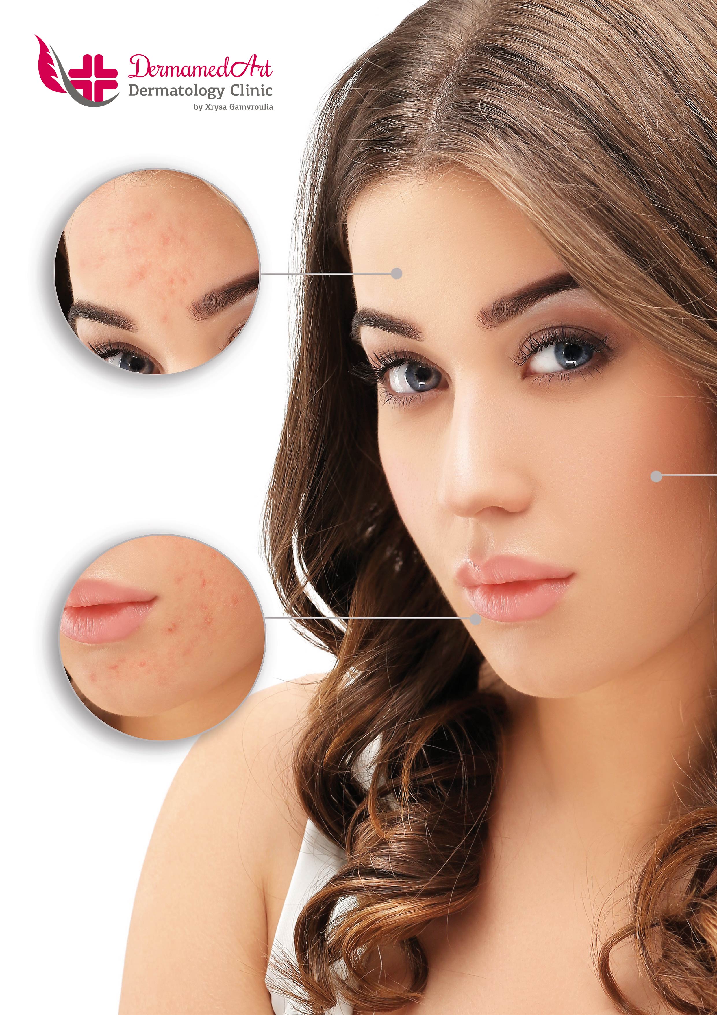 AKMH. FRACTIONAL . ΧΗΜΙΚΑ PEELING
